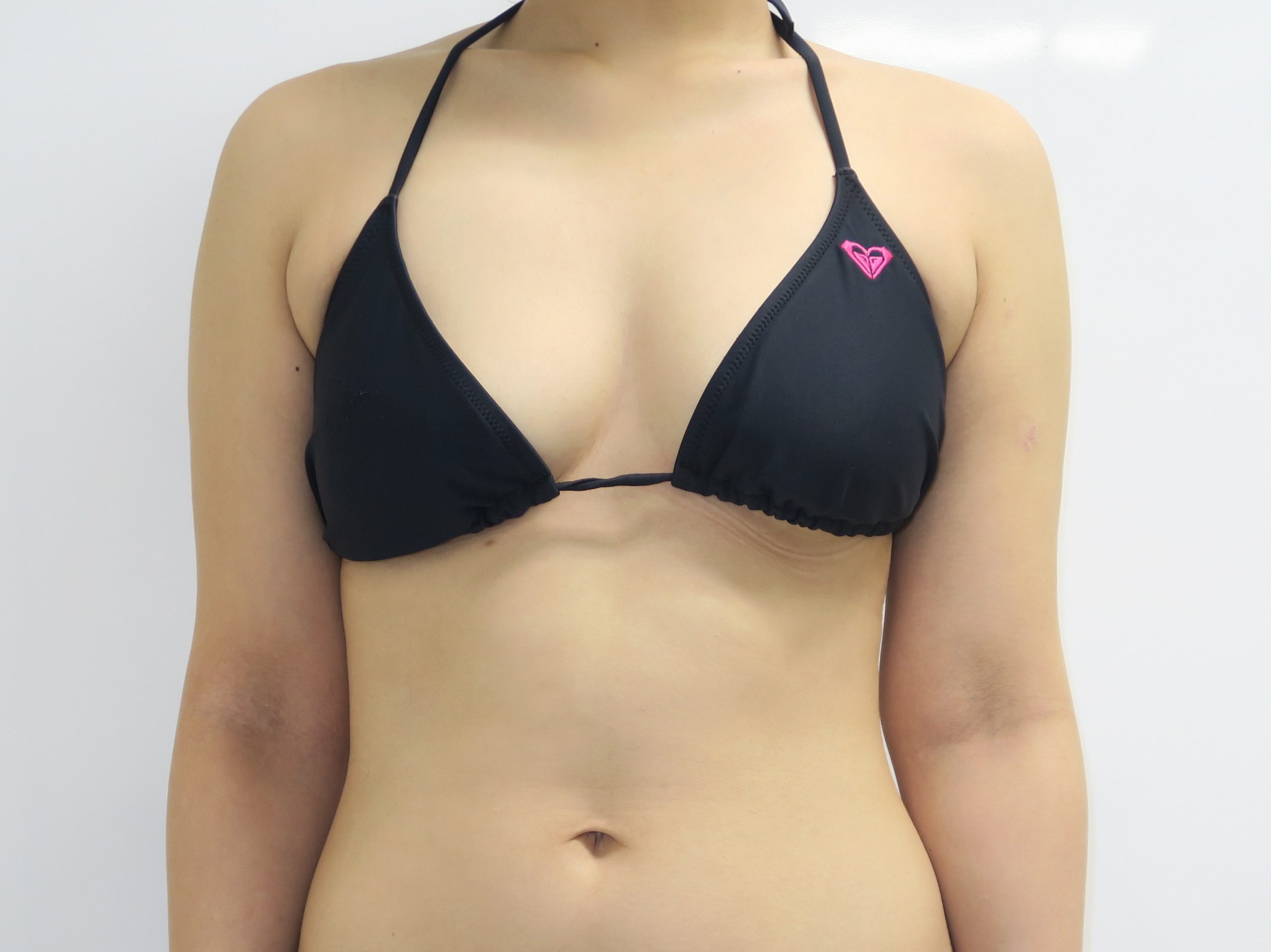 32歳女性　上腕+ワキ後ろ~肩甲骨上+“ワキ前”ベイザー脂肪吸引