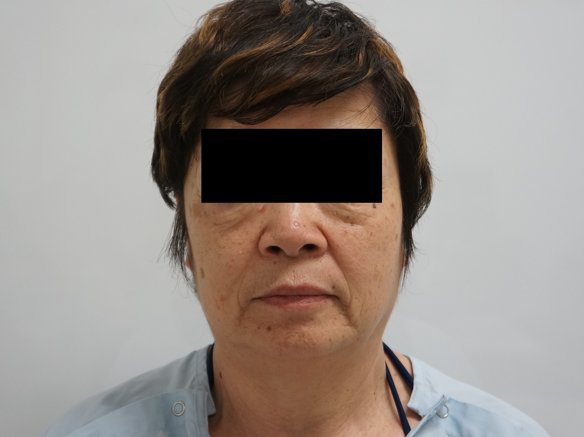 【術後1年】68歳女性　シグネチャーフェイスリフト+頬アゴ下ベイザー+脂肪注入
