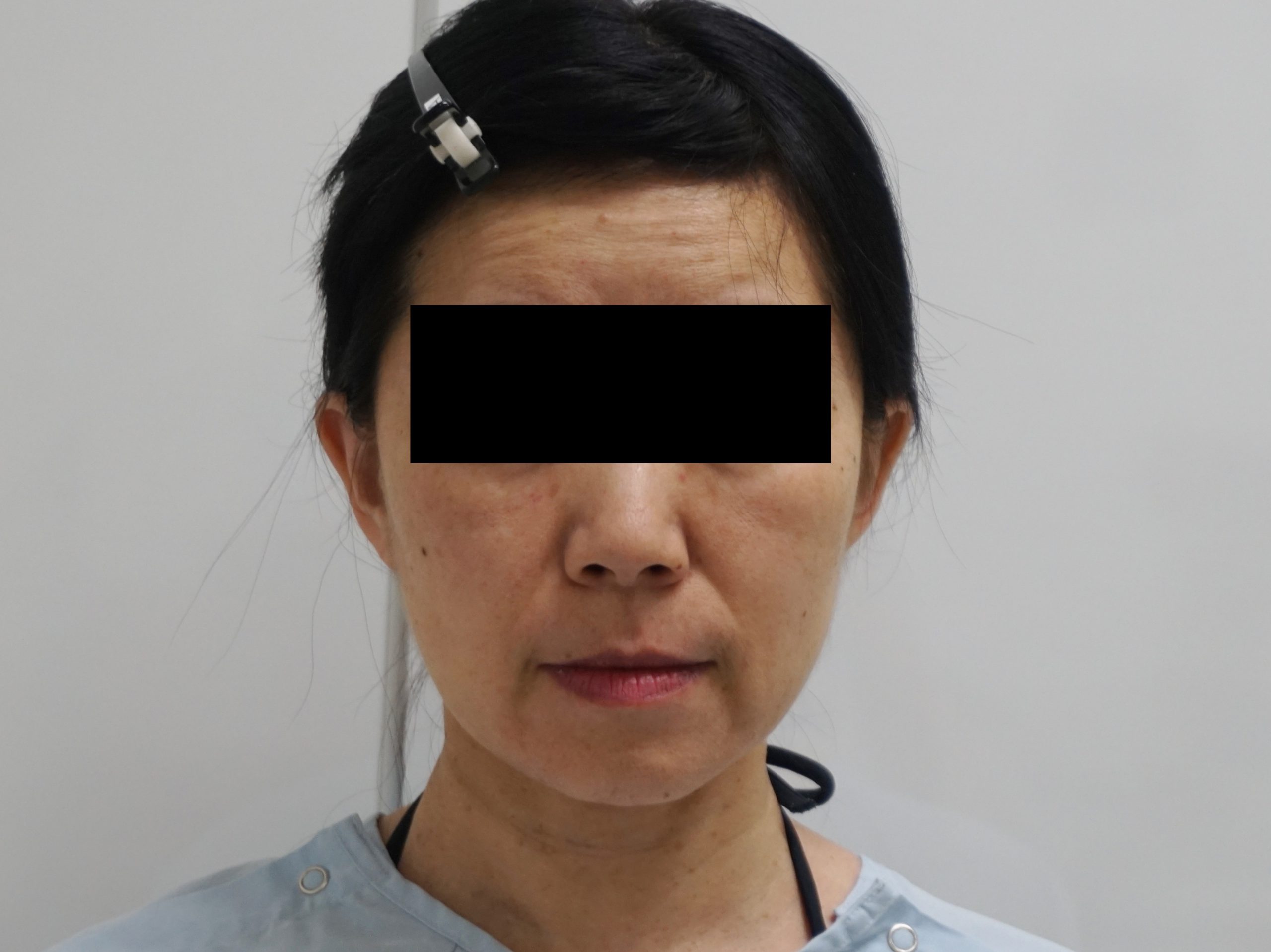 50歳女性　シグネチャーリフト+頬アゴ下ベイザー+脂肪注入（中顔面など）