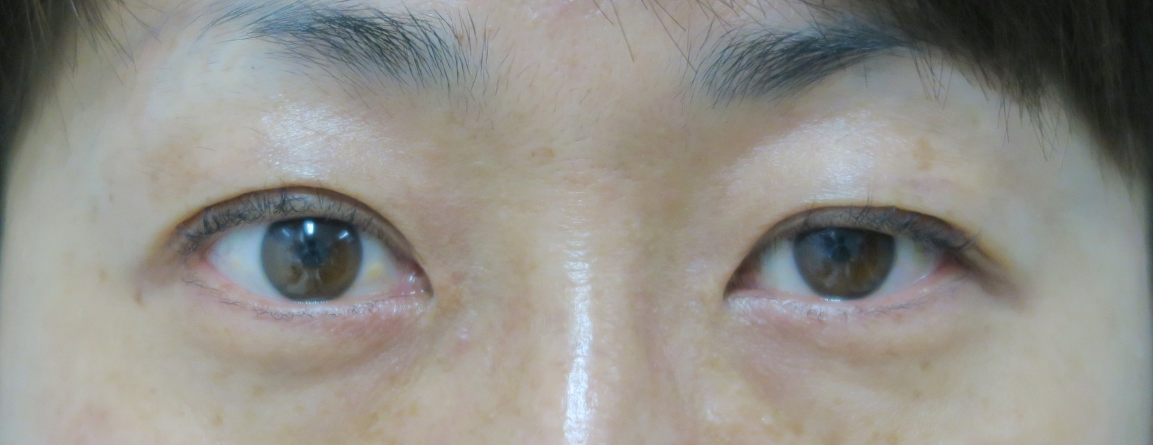 【他院術後】左目眼瞼下垂　末広型→準平行型　　プレミアムクイック