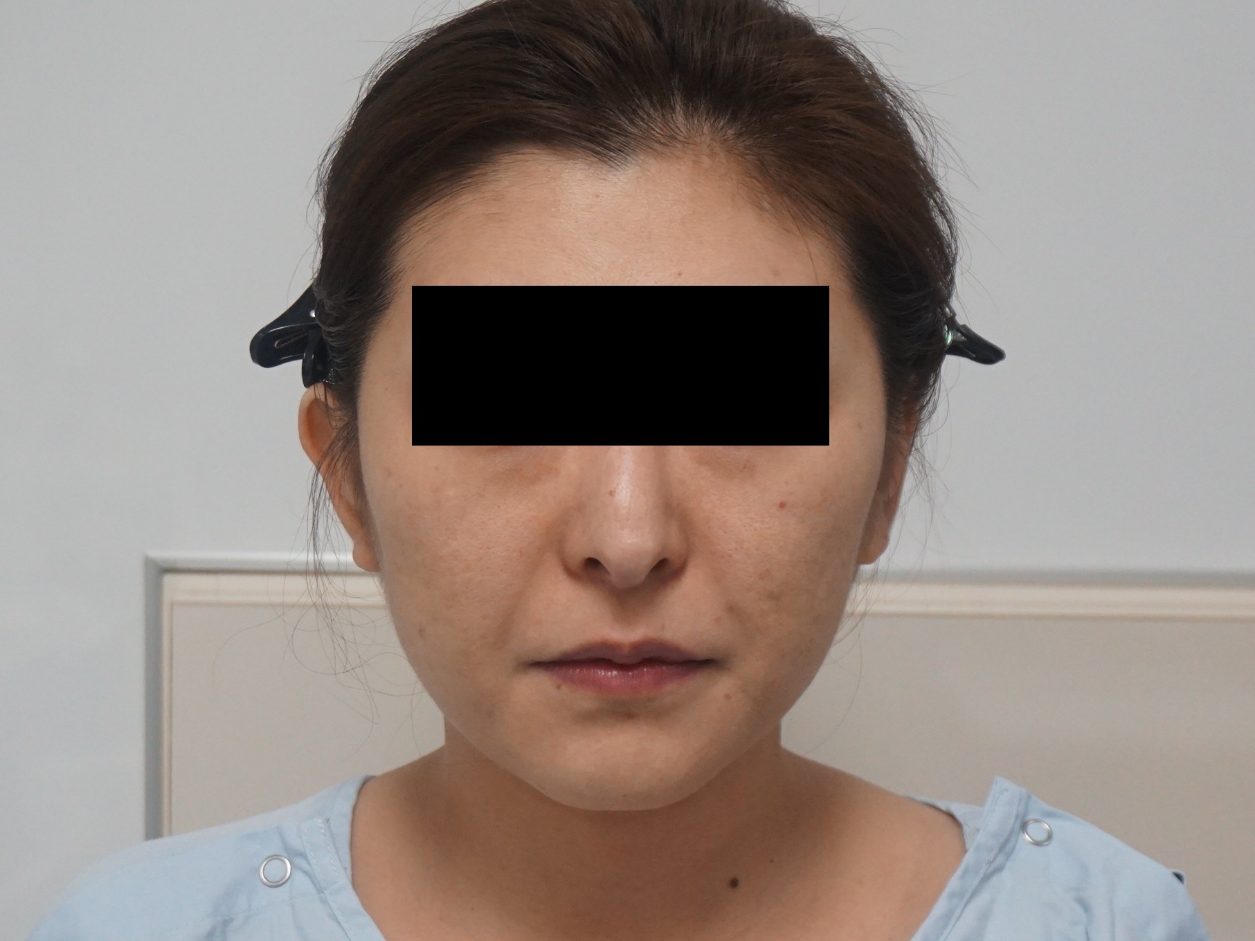 30歳女性　頬・アゴ下ベイザー+ほうれい線・中顔面脂肪注入