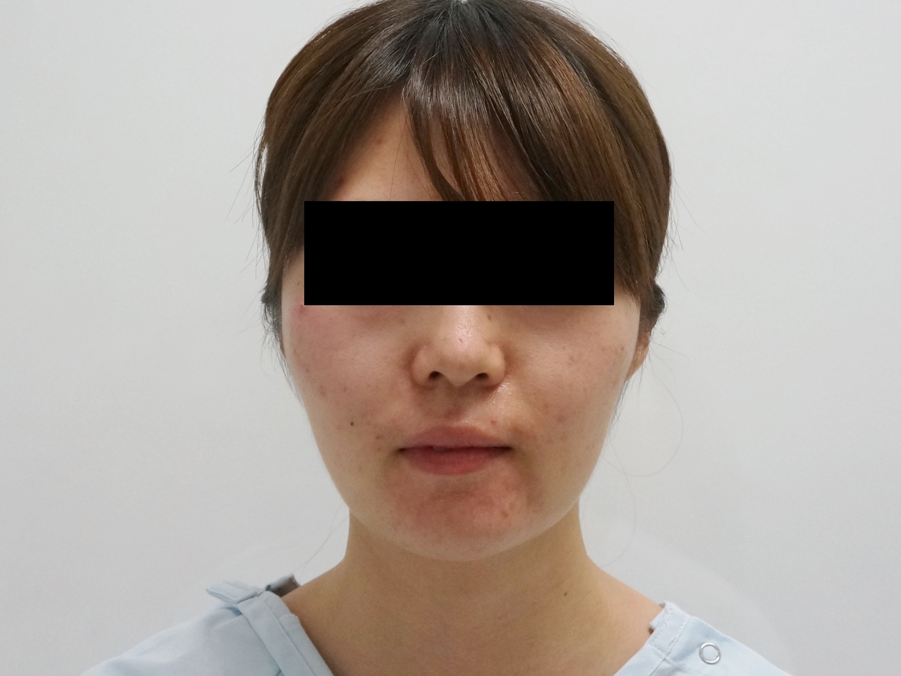 28歳女性　　頬・アゴ下ベイザー脂肪吸引+中顔面・ほうれい線脂肪注入