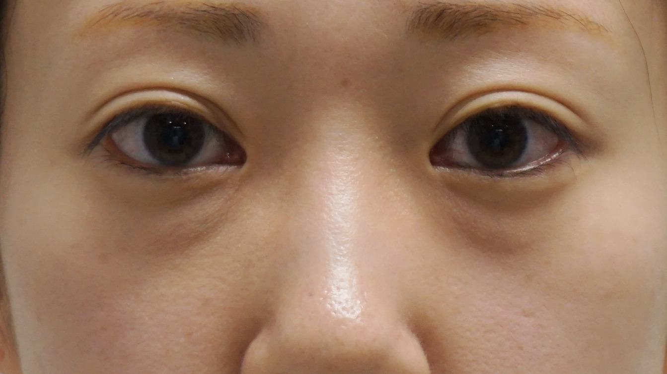 ★83　　32歳女性 経結膜脱脂術+眼窩脂肪注入　疲れ顔にサヨナラ