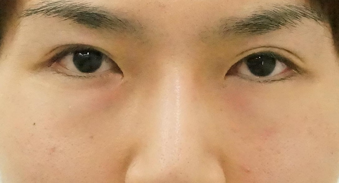 ★85　27歳男性 若い男だってクマ改善でオトコマエ度大幅アップ(9￣^￣)9