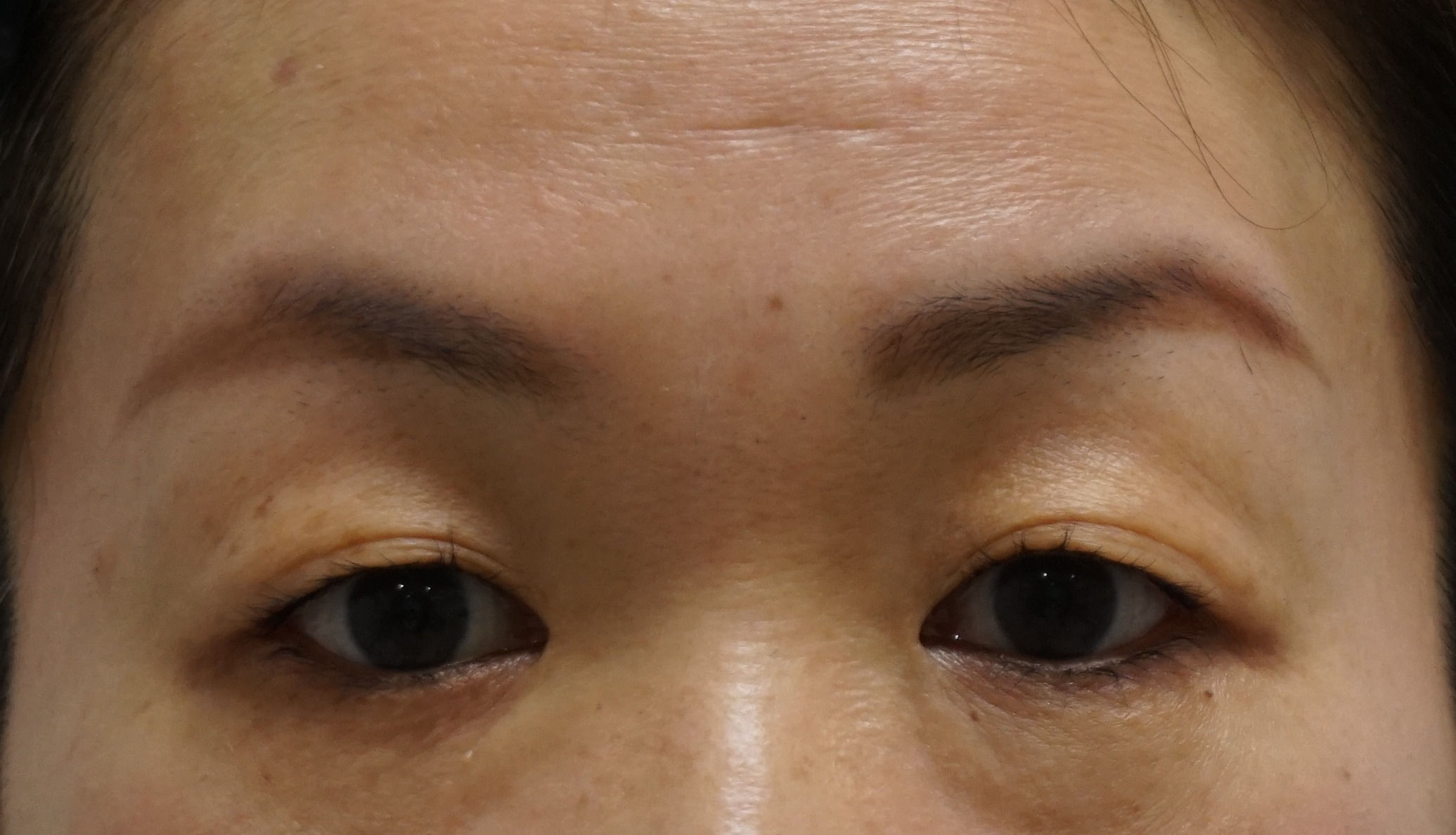44歳女性　　一重が二重になるだけでこんなに若返るなんて！！