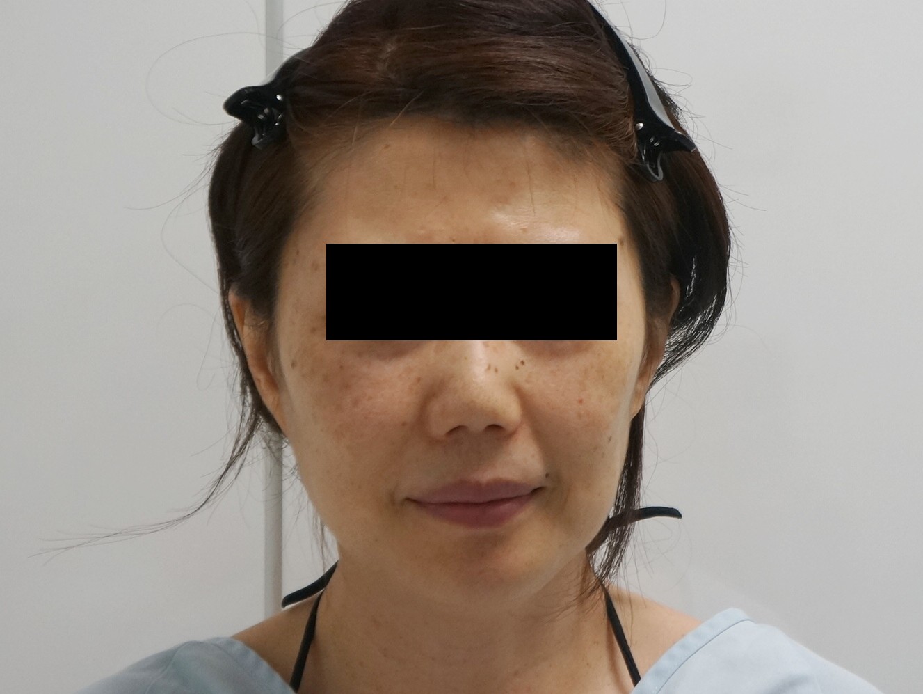 【術後1年7ヶ月】49歳女性　シグネチャーリフト+頬アゴベイザー・中顔面ほうれい線など脂注