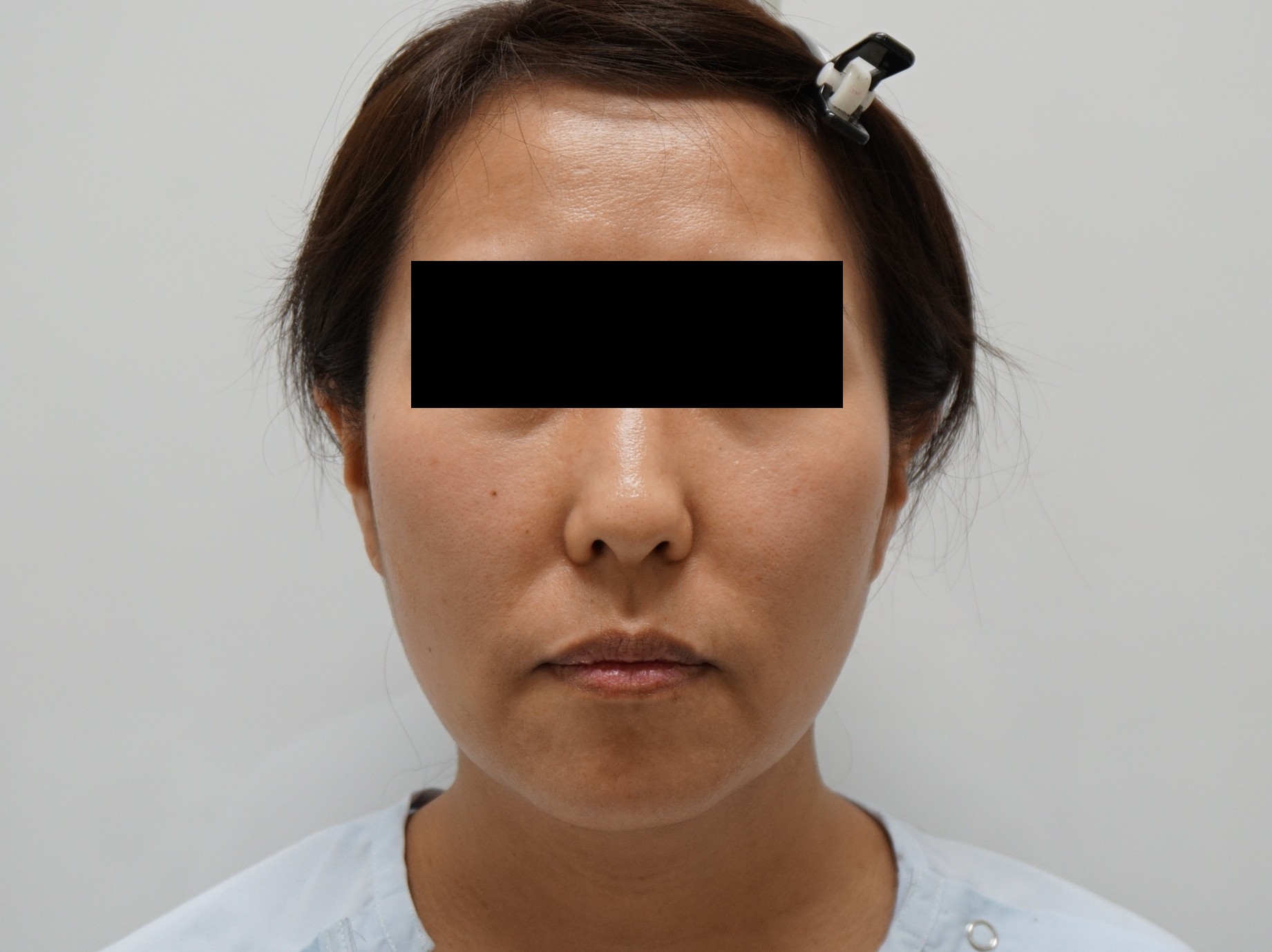 44歳女性　頬アゴ下ベイザー+オトガイ・中顔面・ほうれい線脂注