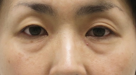 ★91　41歳女性　シワも小じわもある経結膜脱脂術+眼窩脂肪注入