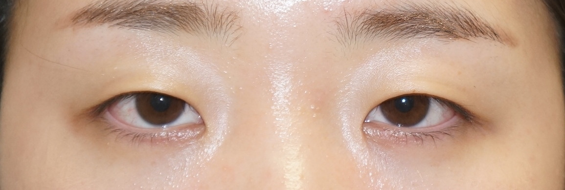 被りの強い蒙古ひだ（眼瞼下垂あり）目頭切開とセミプレミアムクイック　1年後まで