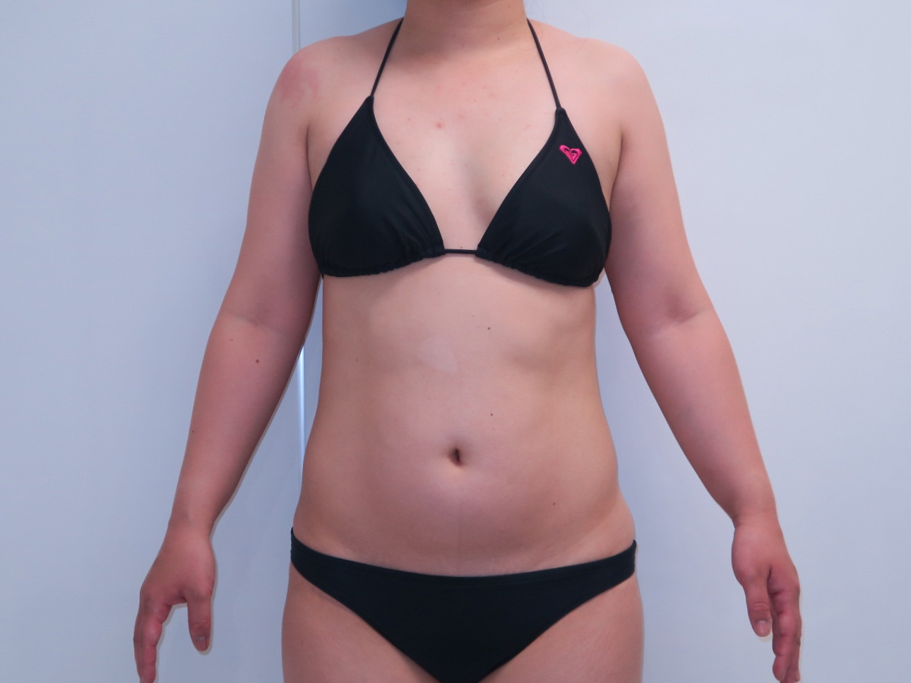 35歳女性　163cm67kg　　お腹周りのベイザー脂肪吸引