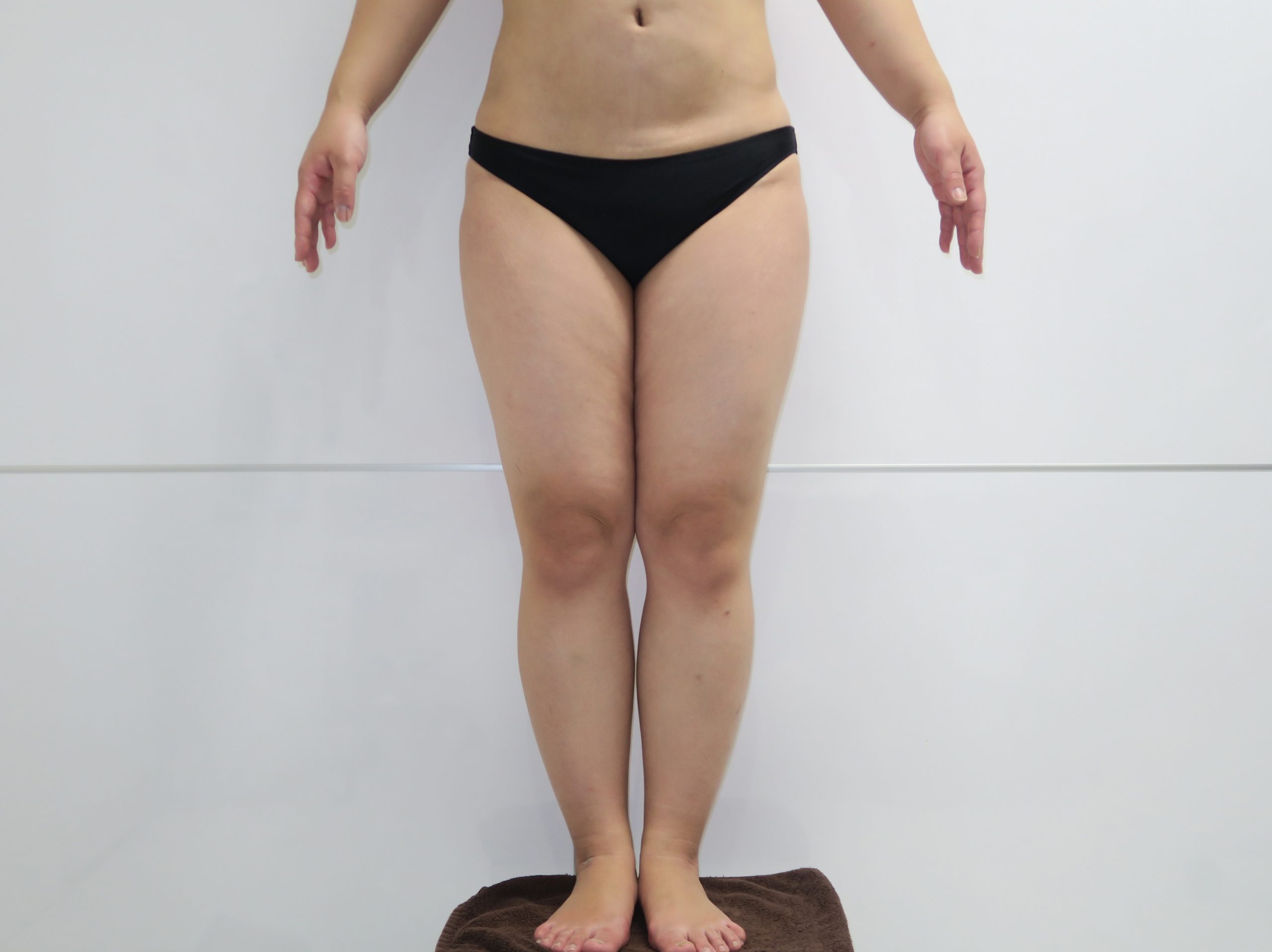【片脚ずつ吸引】35歳女性　163cm67kg　大腿臀部膝周りベイザー脂肪吸引