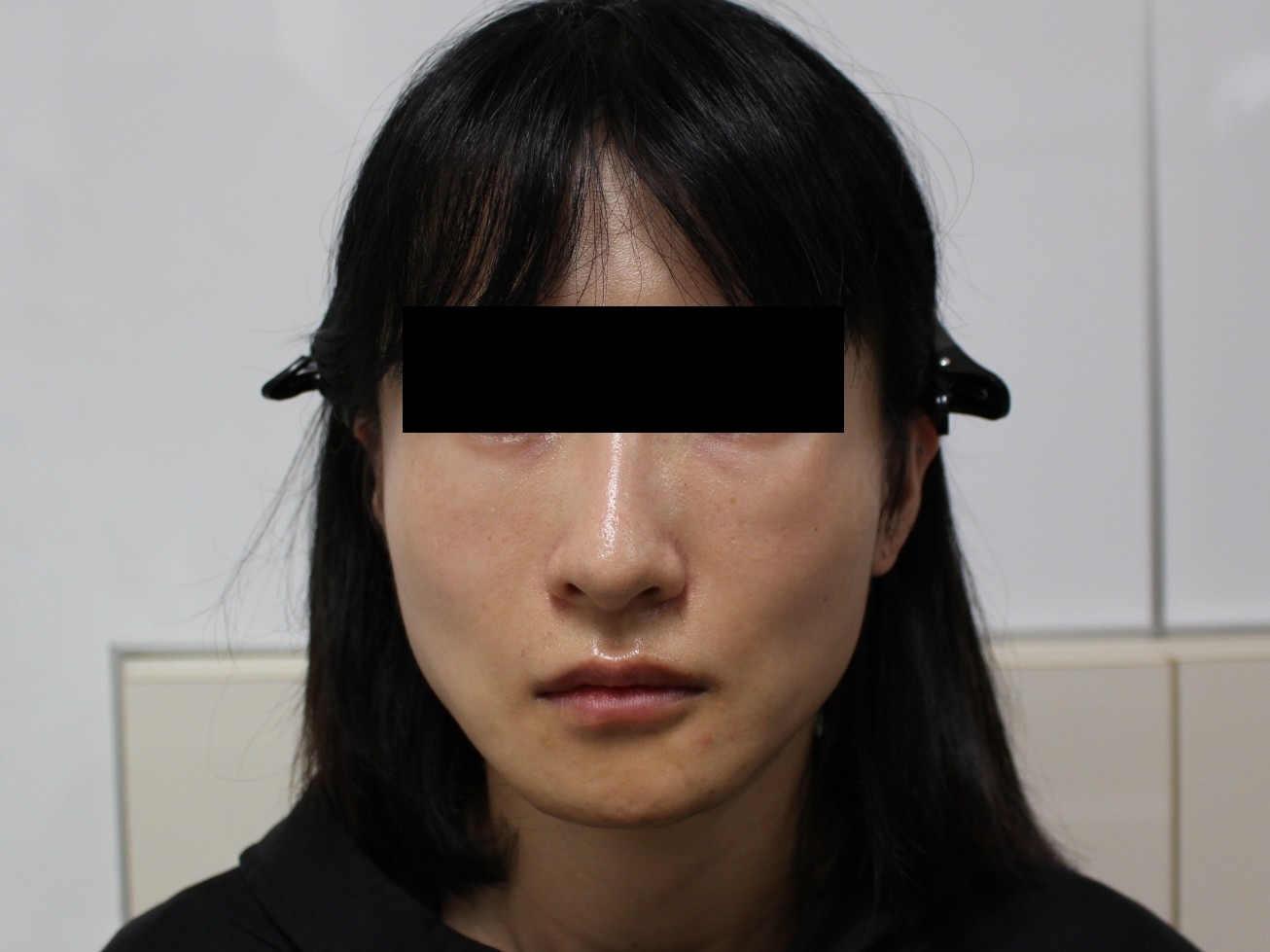 【アーチリダクション後】ジュビダーム ボリューマでふっくらきれいに修正