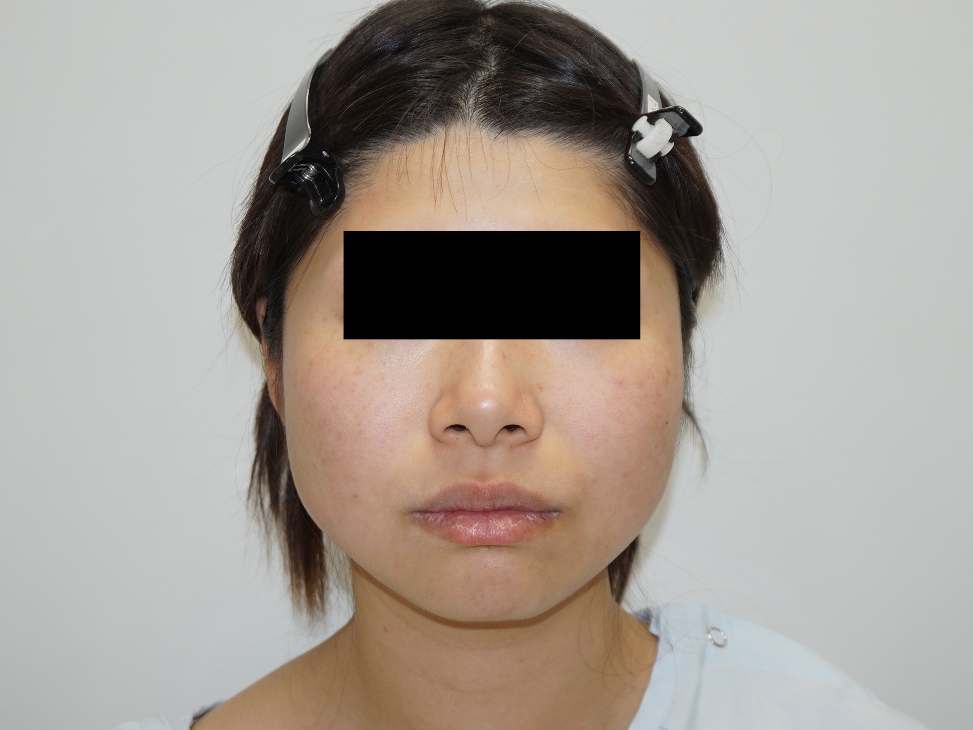 ★91　【他院修正　圧倒的効果】30歳女性　頬アゴ下ベイザー脂肪吸引+エラボトックス