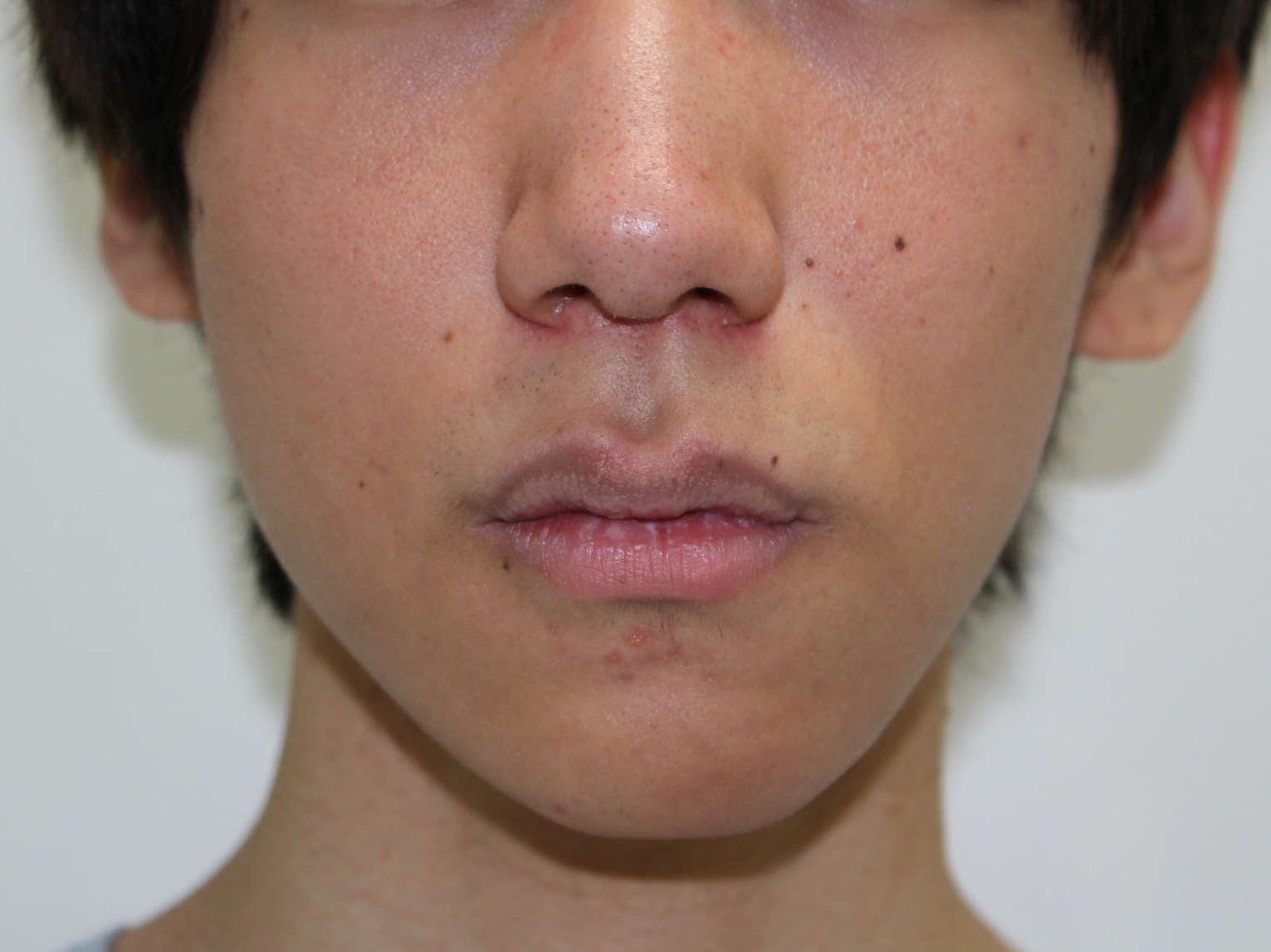 ★6　19歳男性　唇を薄くして涼し気な口元に
