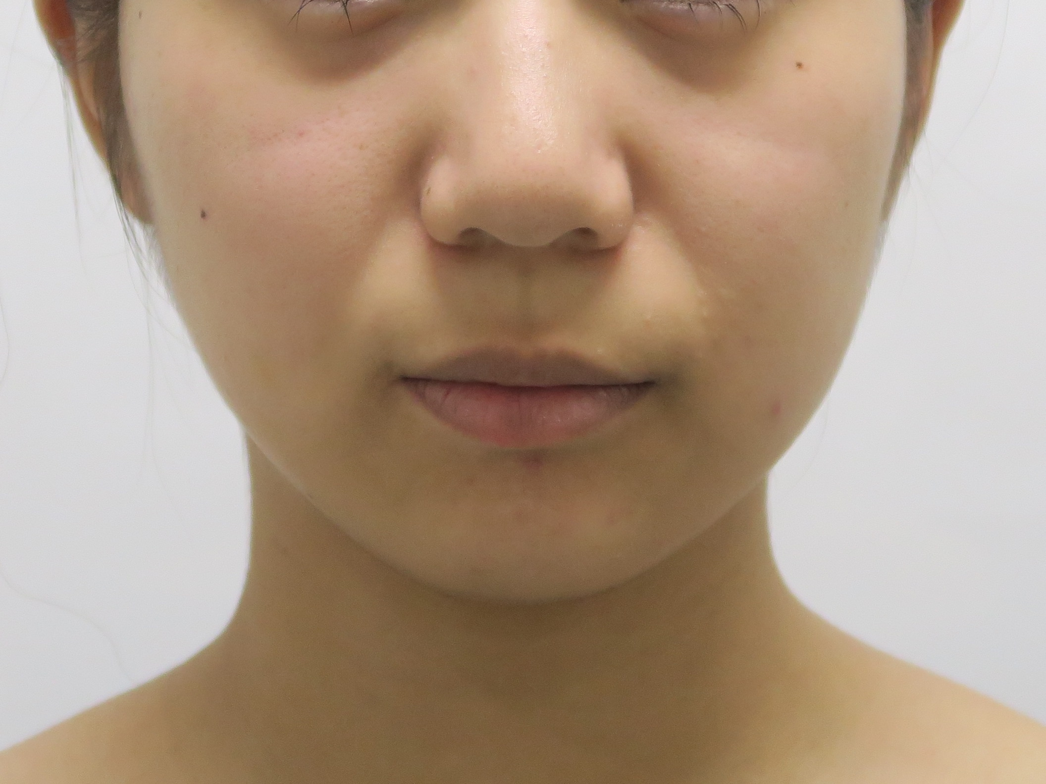 21歳女性　ほうれい線がどうしても気になる　ジュビダームXC（ウルトラ）で消失！！