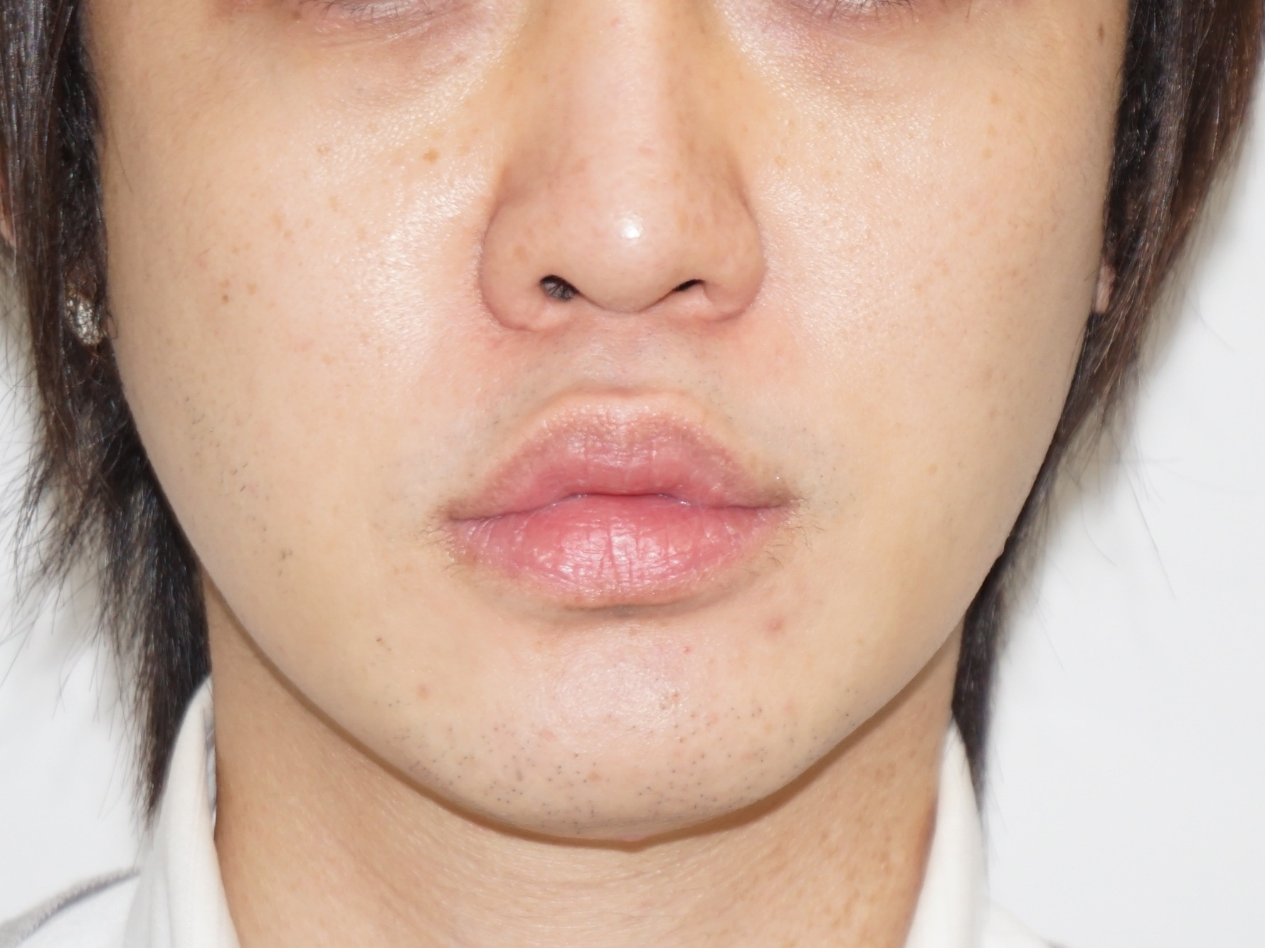 ★5　33歳男性　唇を薄くする手術　10ヶ月後