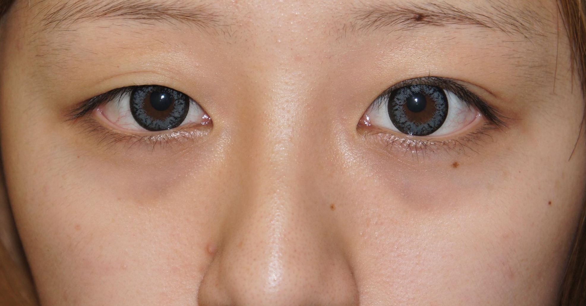 ★98　24歳女性　この若さでクマ・・・　経結膜脱脂術+脂肪注入で改善