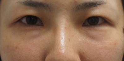 ★36　　37歳→41歳（4年8ヶ月）　経結膜脱脂術+眼窩脂肪注入