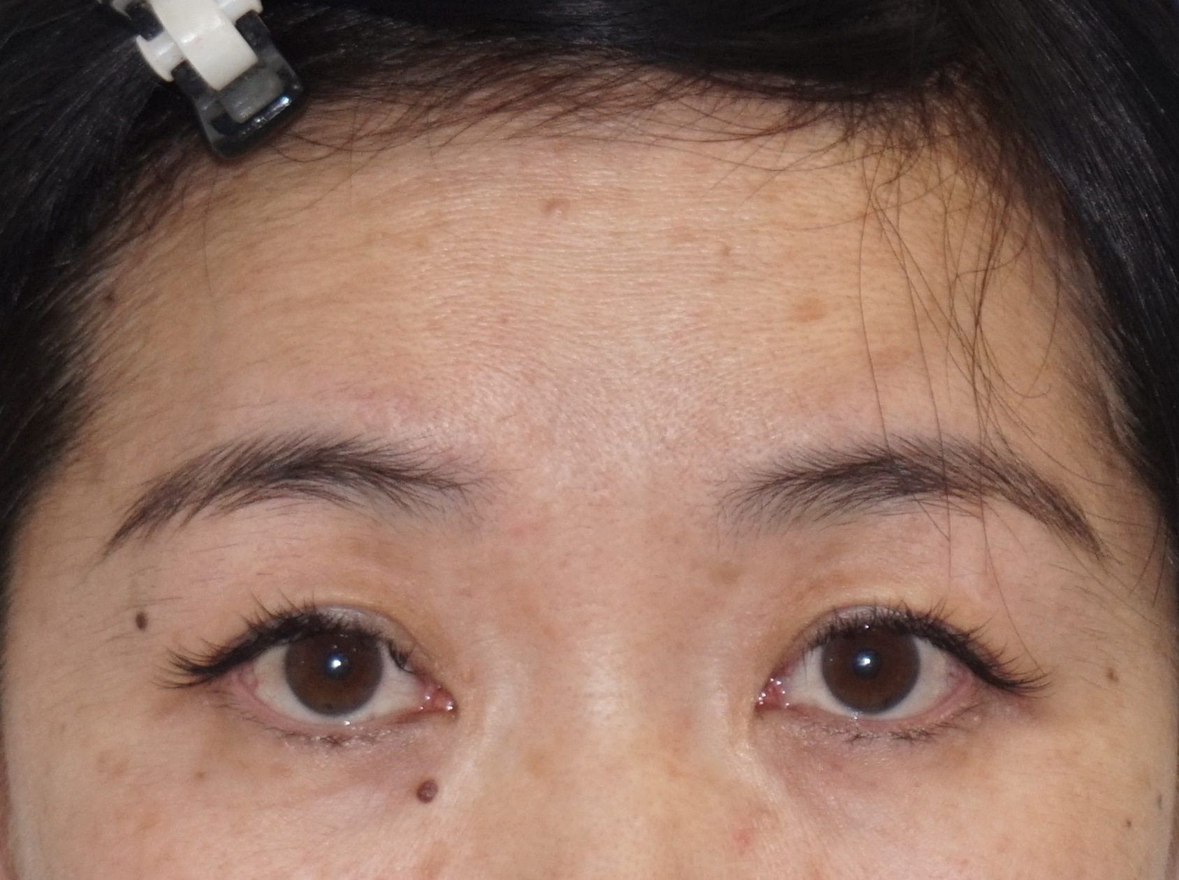 ☆5-2　【術後1年】50歳女性　眉下切開によるたるみ取り