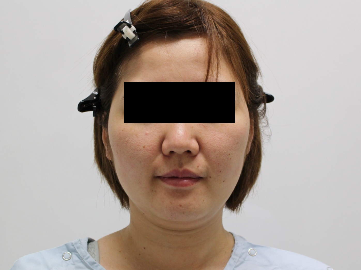 ★93　32歳女性　　ベイザー頬アゴ脂肪吸引+ほうれい線・オトガイマリオネットライン脂肪注入