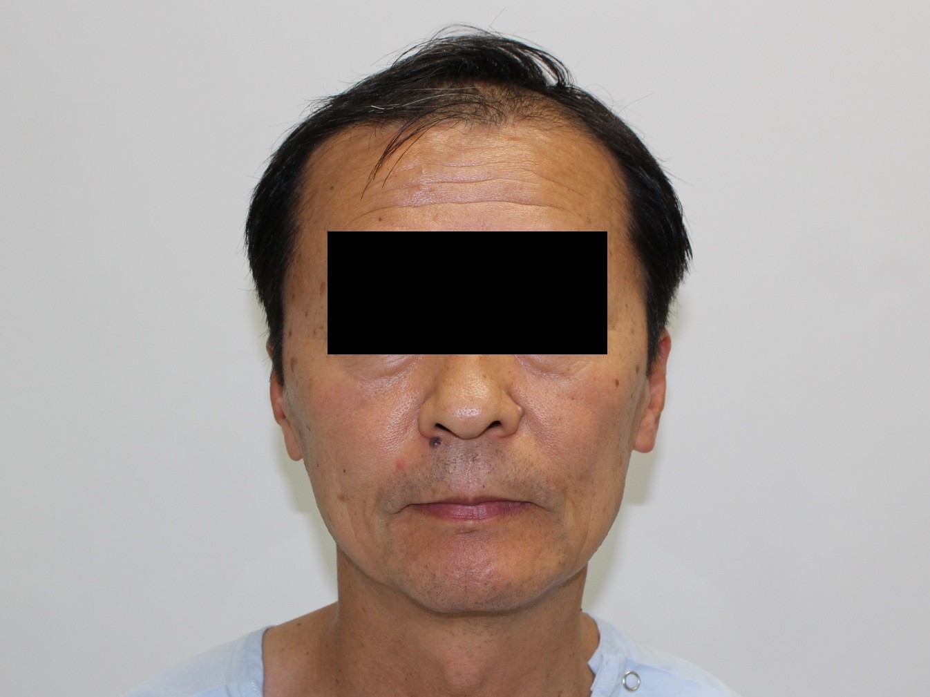 58歳男性　シンシアの毛髪再生医療で4ヶ月でこんなに生えた（円形脱毛症部も生えた！！）