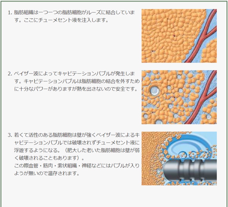 目の下のクマにおけるマイクロコンデンスリッチファット（マイクロCRF）とピュアグラフト