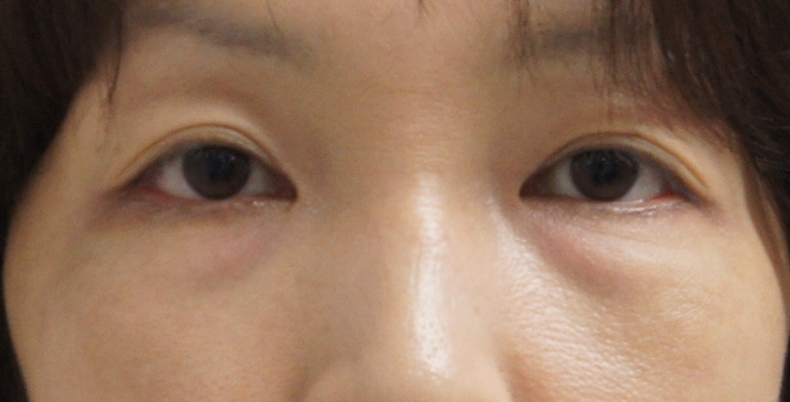 ★25　【術後5年半！！】46歳女性目の下のたるみとり（脂肪除去と脂肪注入同時に）