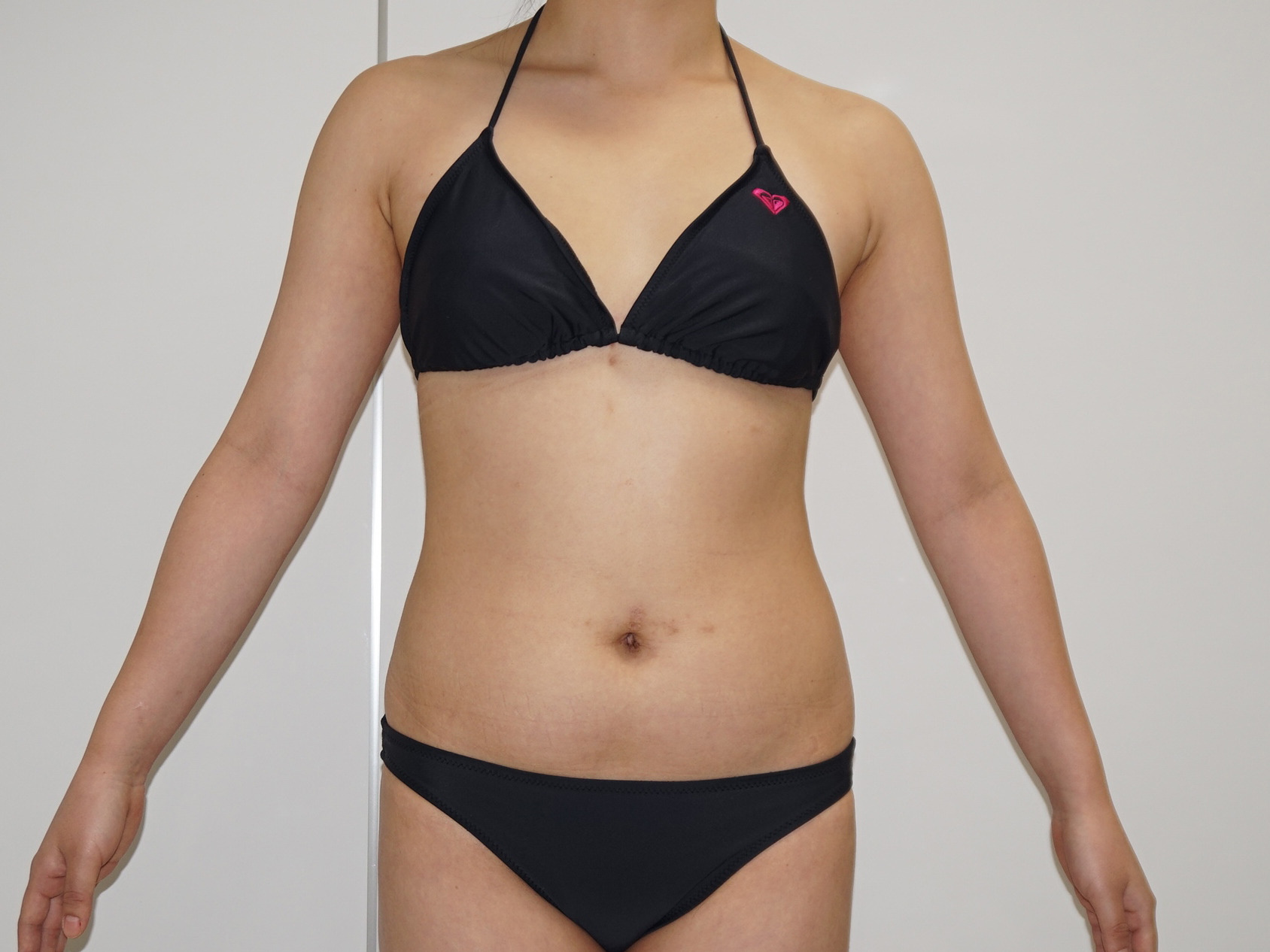 25歳女性　腹部腰部ベイザー脂肪吸引　3ヶ月まで