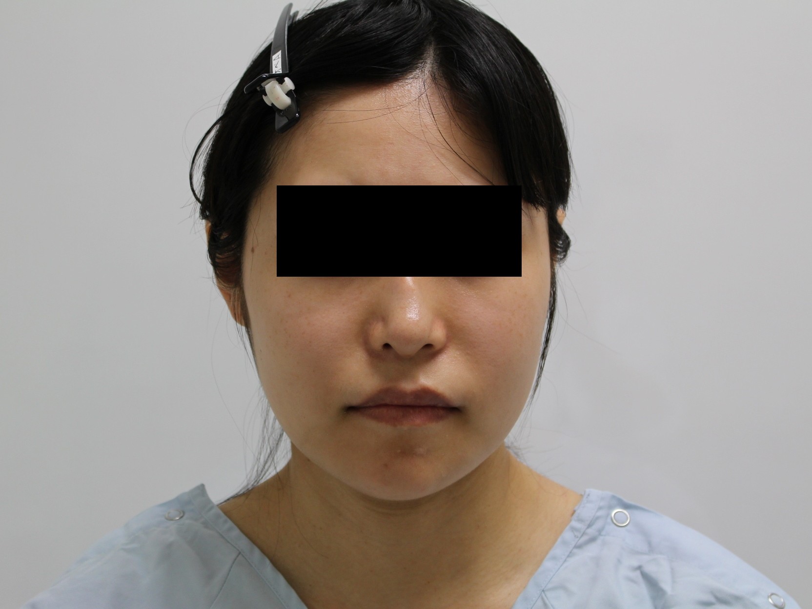【半年後】★95　26歳女性　頬・アゴ下ベイザー脂肪吸引+中顔面・ほうれい線脂注　2