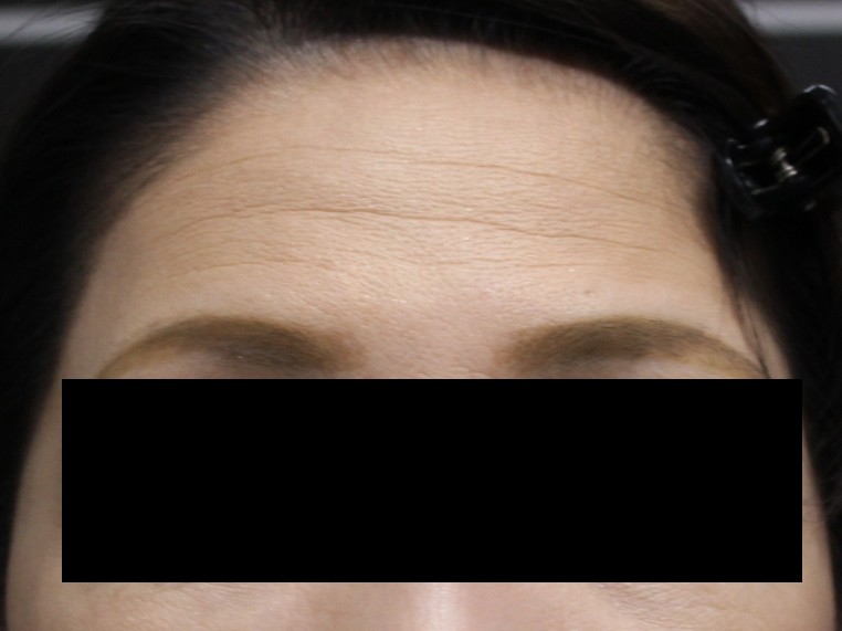 51歳女性　VOLUMA2cc+ジュビダームXCウルトラ1cc　可愛くてまるいおでこに