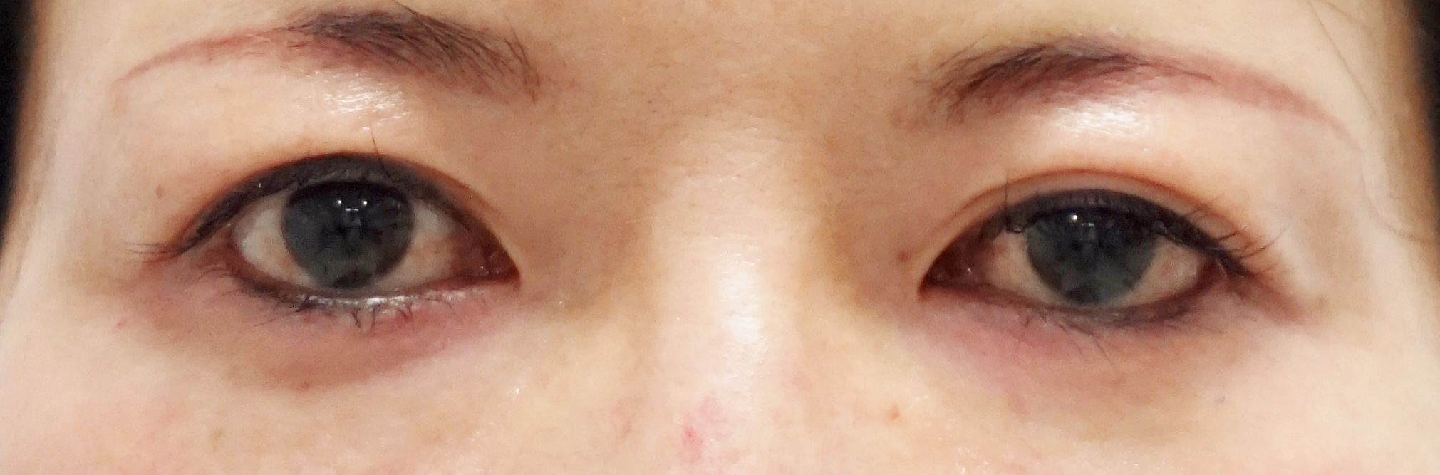 【術後18ヶ月】左目だけの眼瞼下垂あり　　埋没法→左目眼瞼下垂手術（腱膜固定術）
