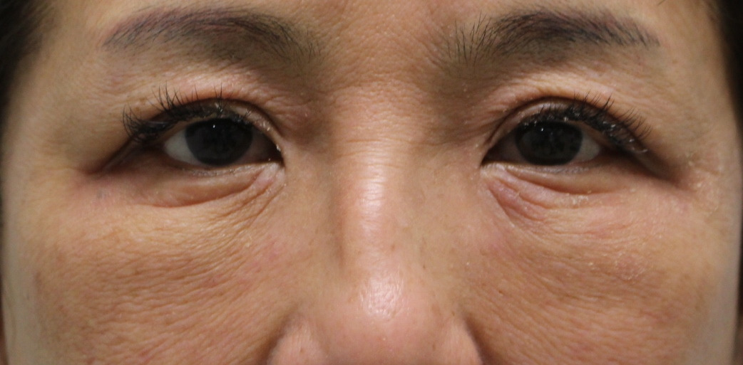 術者がびっくりするほど腫れが少なくて効果が高かった目の下のたるみ取り【切開あり】