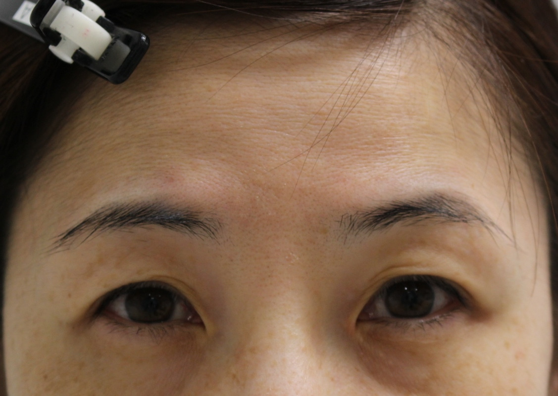 ☆8　45歳女性　眉下切開による上瞼のたるみ取り