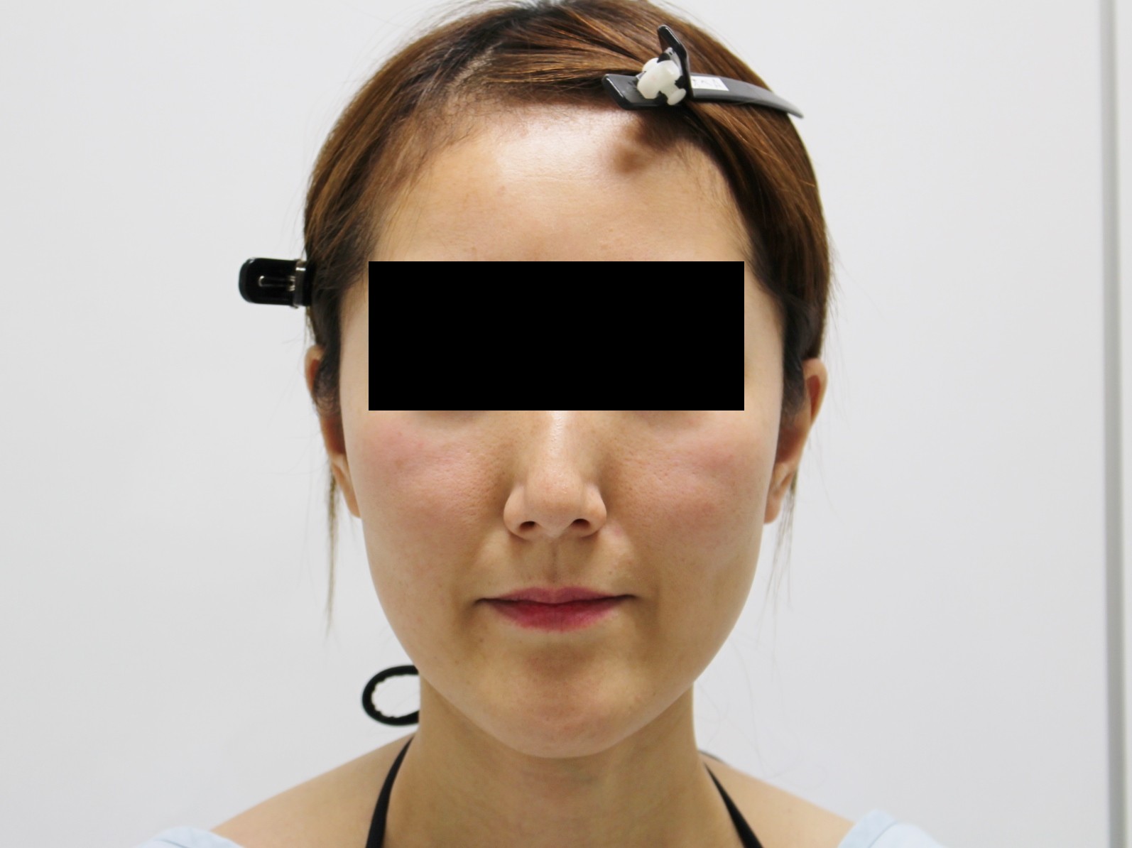 【ゴルゴ線消失】41歳女性　ミントリフト5本+5本　 中顔面（ゴルゴ線）剥離+脂肪注入