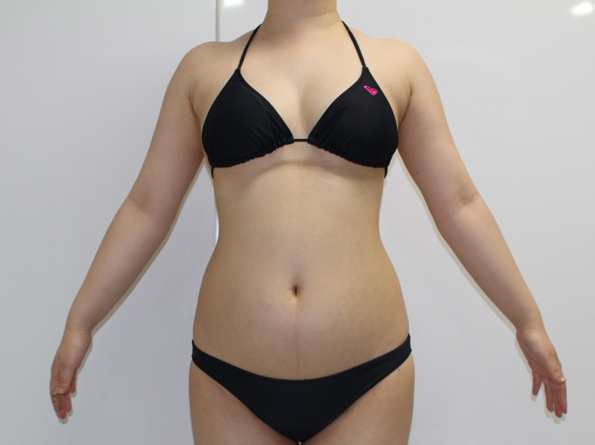 34歳女性　166cm62kg　ベイザー腹部・腰部脂肪吸引　半年まで　