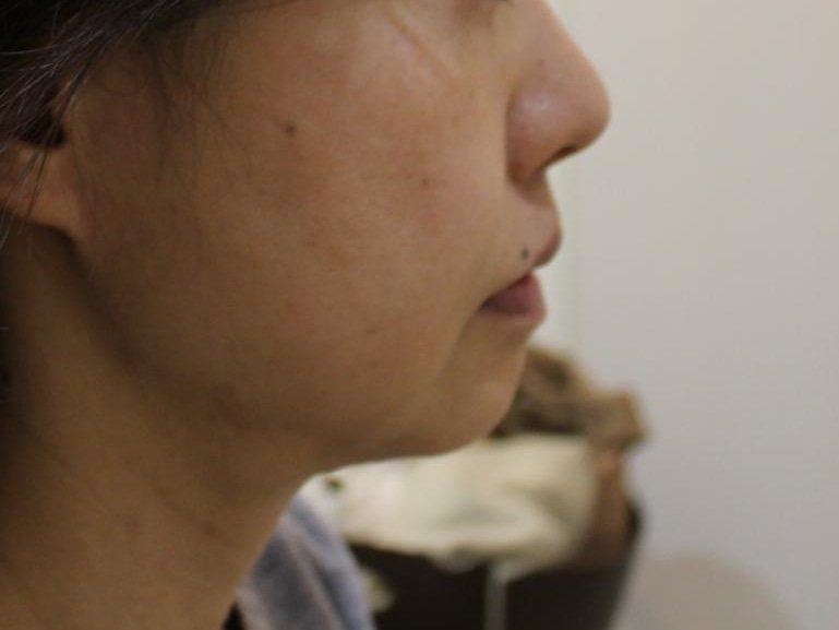 49歳女性　アゴのクレヴィエル　1本（1cc）でマイルドな変化