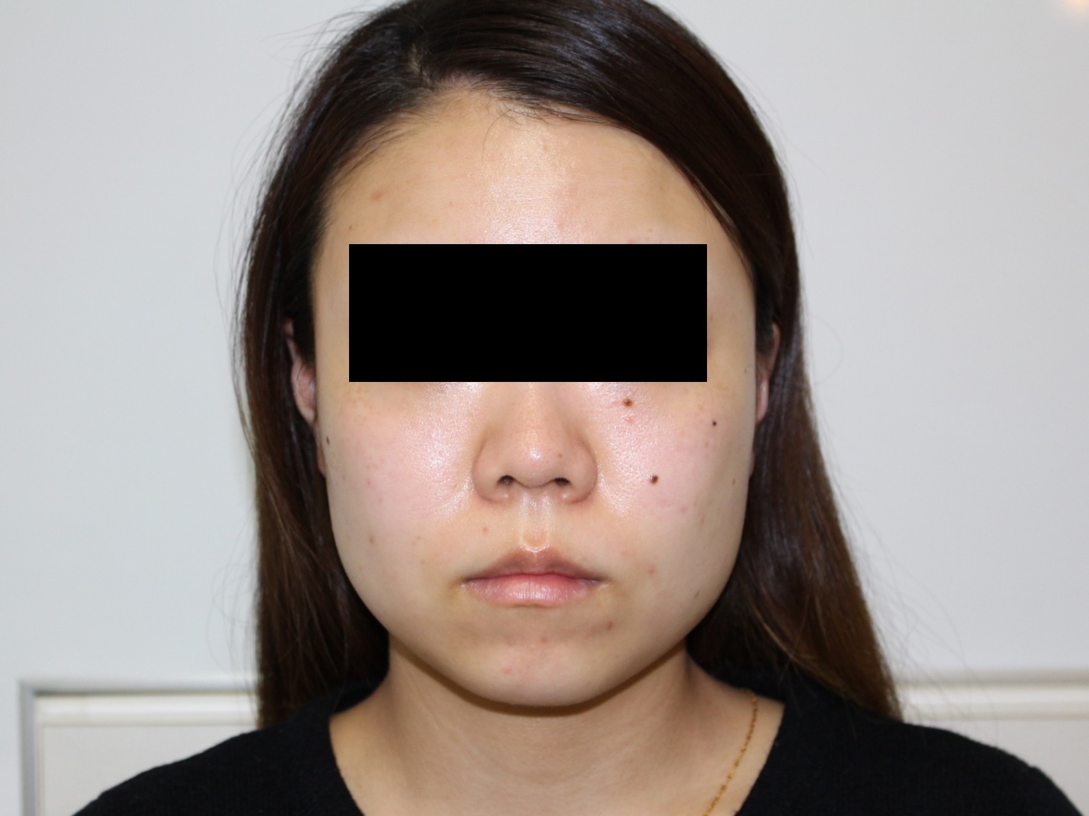25歳女性　エラボトックスビスタ　　　優しげな印象に