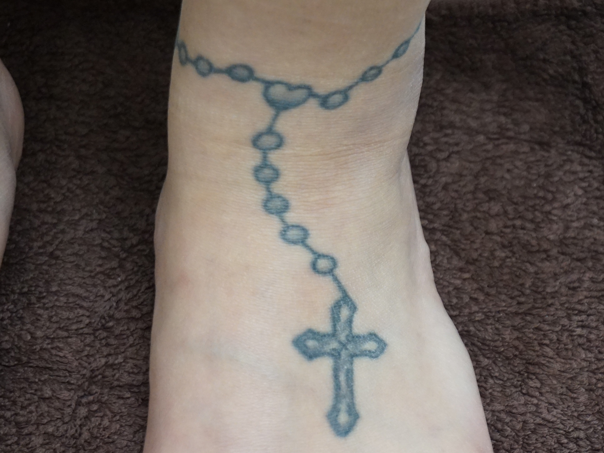 足首から足背にかけての黒単色Tattoo　レーザーでの治療