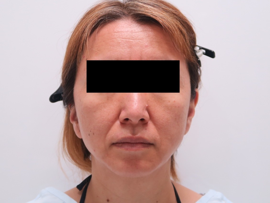 術後2年★35　47歳女性 シグネチャーリフト+頬アゴ下ベイザー・脂注(中顔面・ほうれい線など）