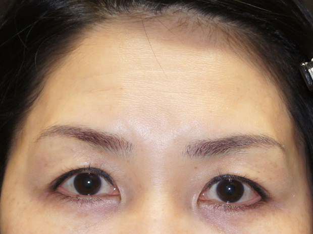 ☆10　眉下切開による上まぶたたるみ取りで優しげな印象に
