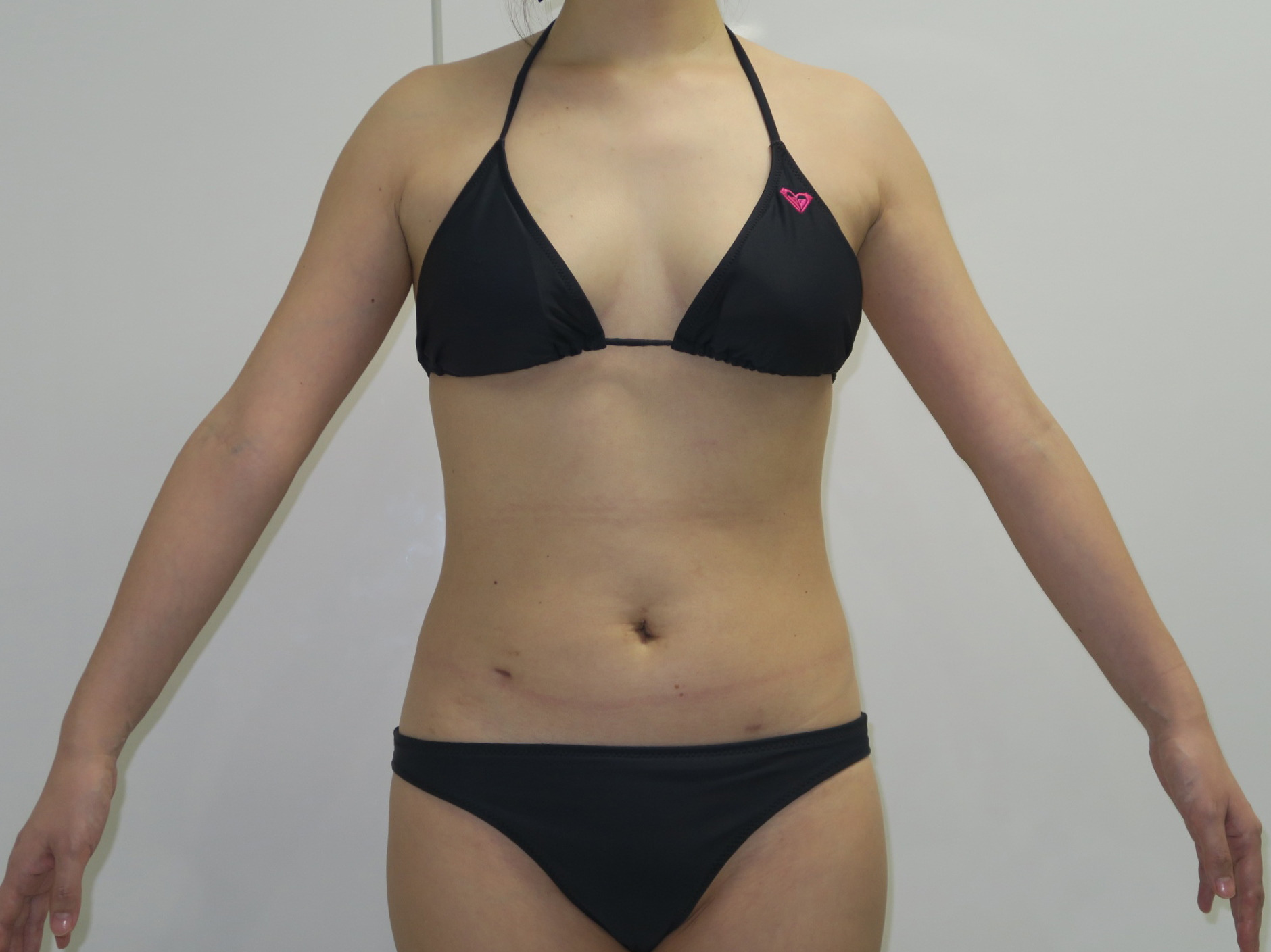 ★67　33歳女性　腹部腰部（下背部）ベイザー脂肪吸引　1年後まで