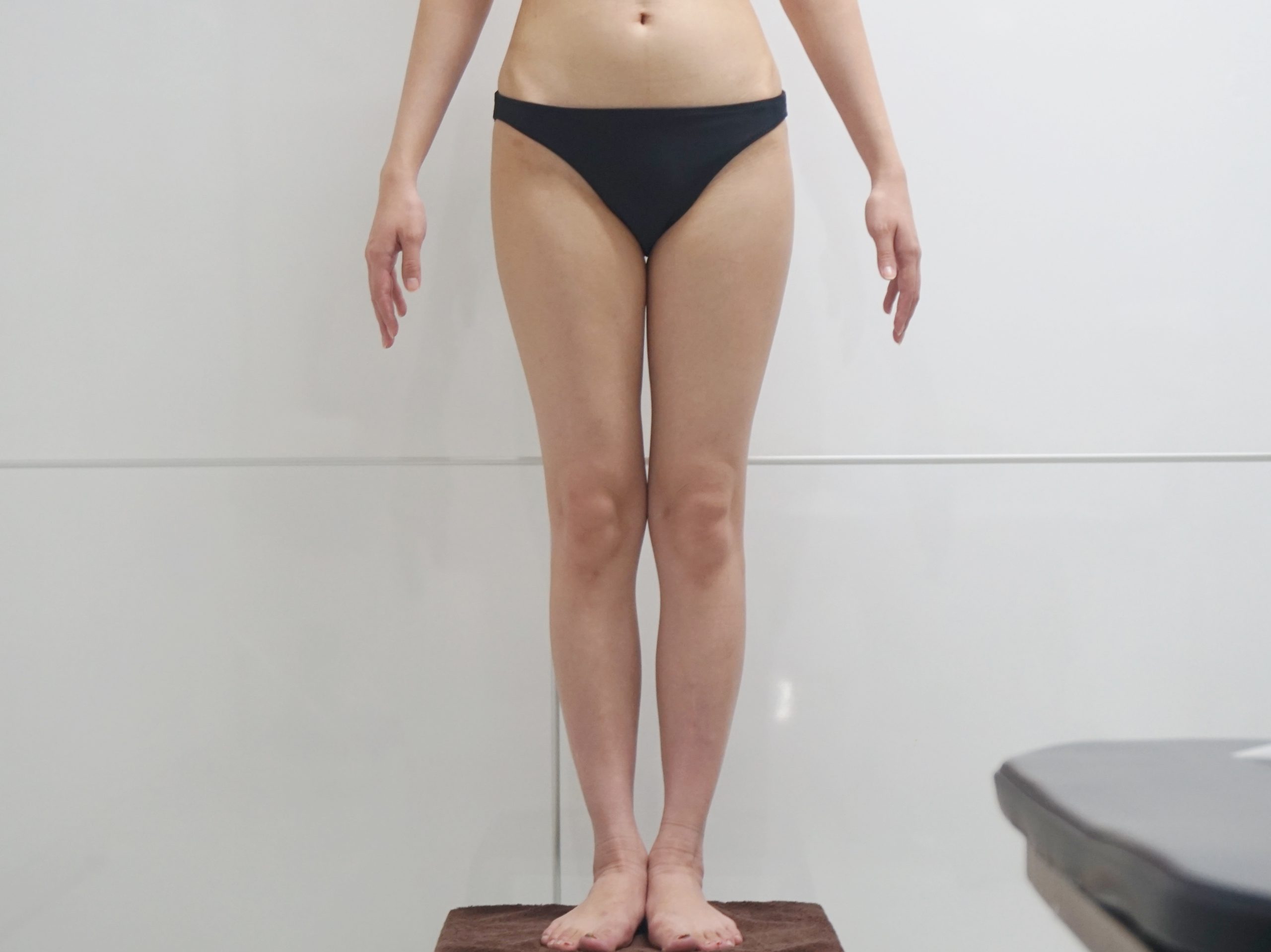 【1年後】25歳女性　それほど太くない大腿臀部膝周りVASER+CRF豊胸　
