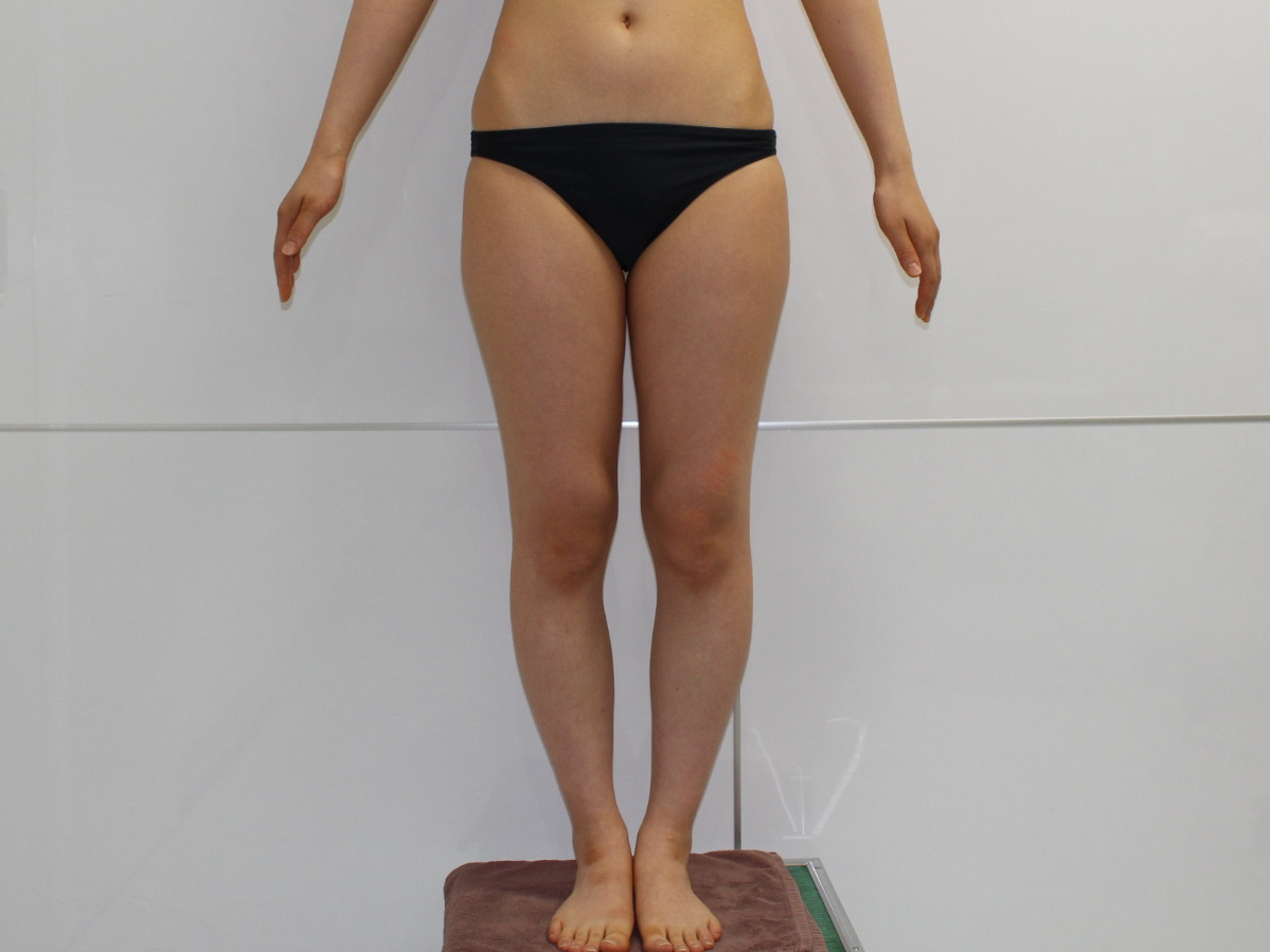 ☆89　29歳女性　大腿臀部膝周りベイザー
