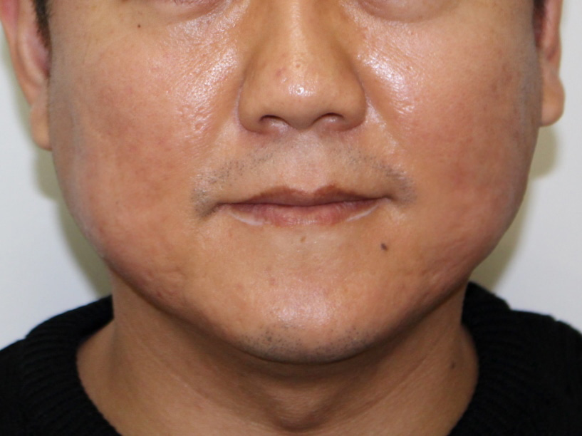 40歳男性　エラボトックスビスタで周りの人から”痩せた？”