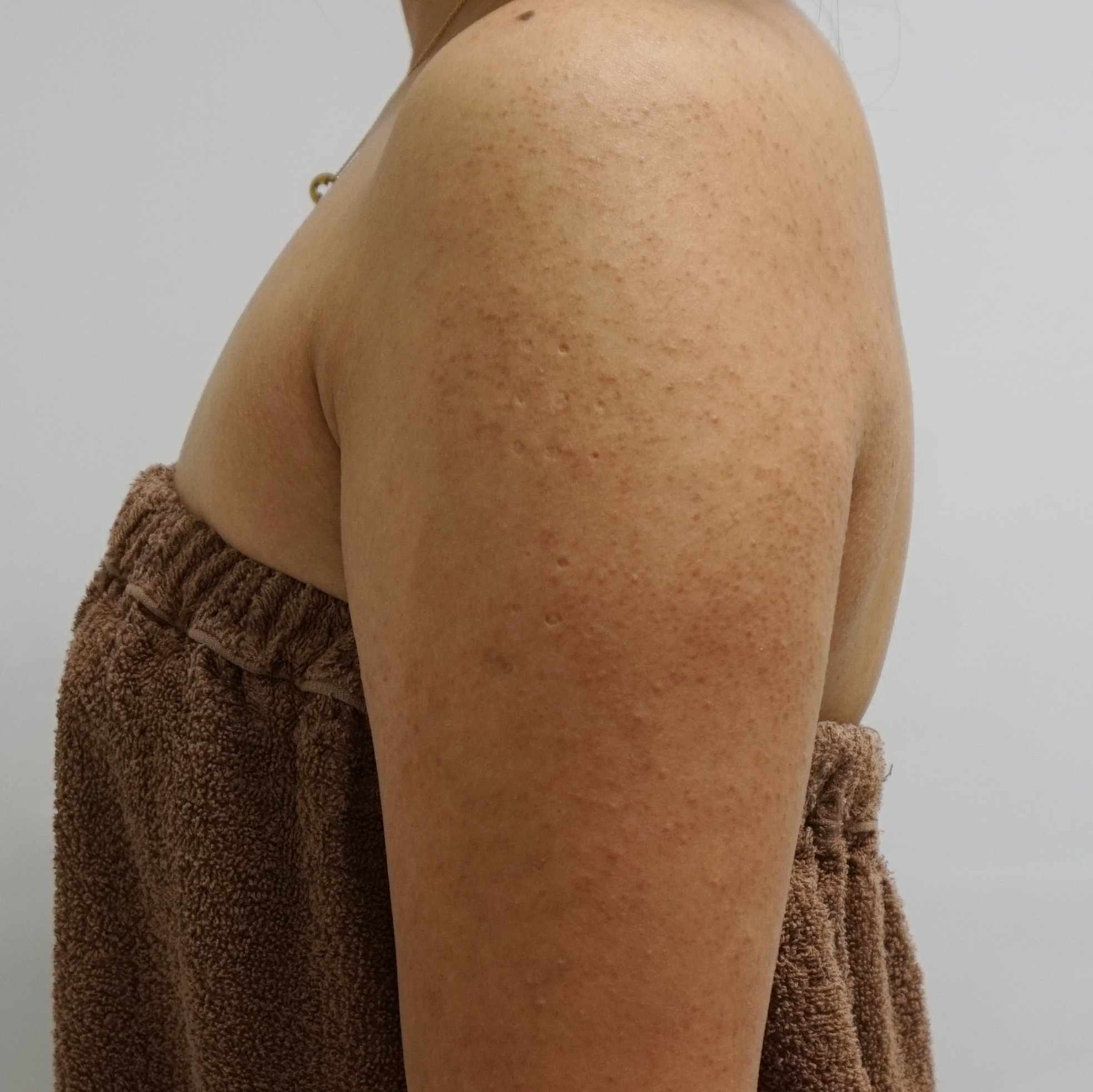 23歳女性　　毛孔性苔癬（二の腕）ダーマローラ治療2回後