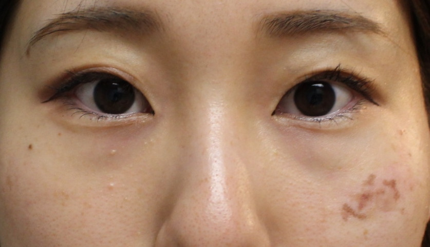 ★123　25歳女性　経結膜脱脂術+眼窩脂肪注入→プレミアムクイックで末広型