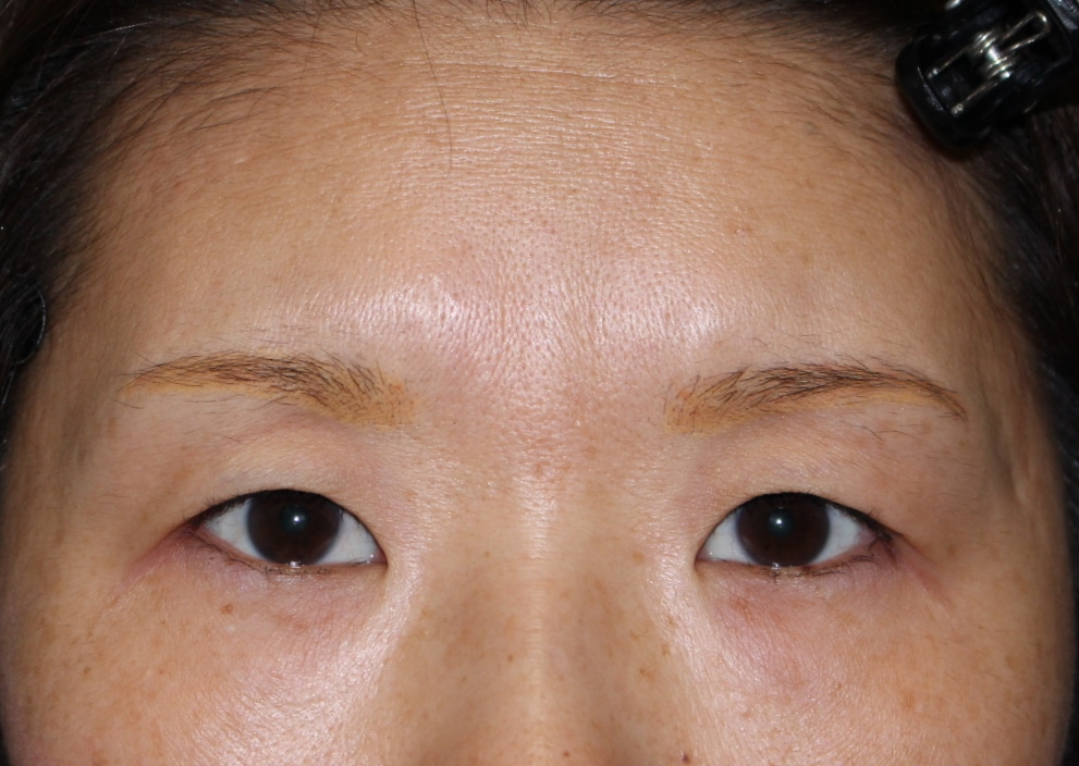 ☆7-2　【1年後】45歳女性　他院二重切開術後　眉下切開によるたるみ取り　