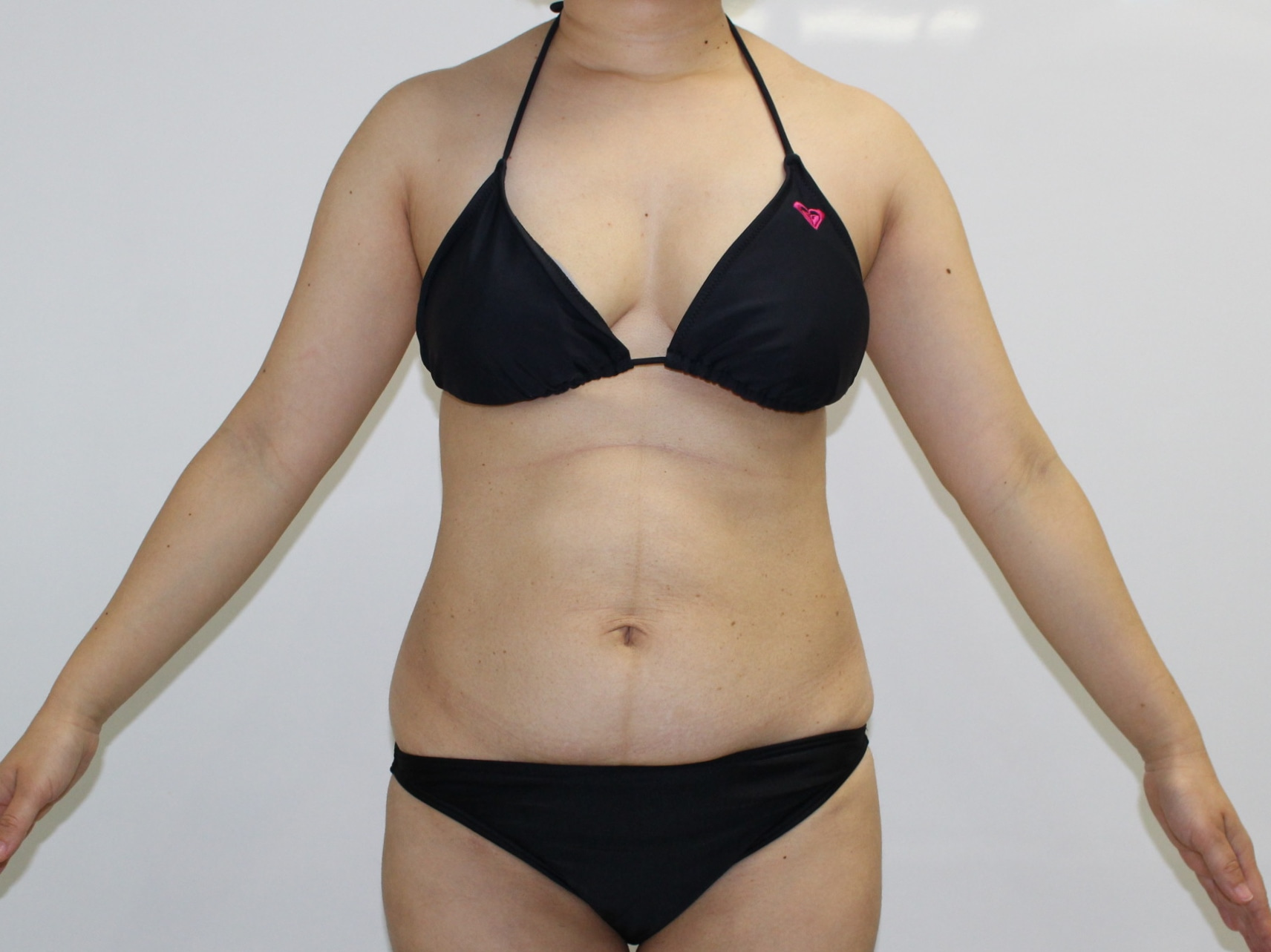 腹★68　35歳女性　他院で断られた腹部腰部ベイザー脂肪吸引（+皮膚切除のたるみ取り）
