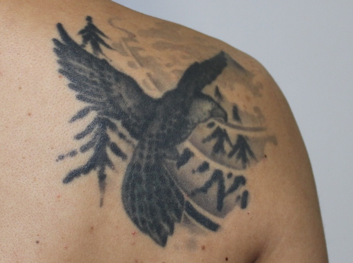背中～肩にかけてのTattoo　レーザー除去　3回