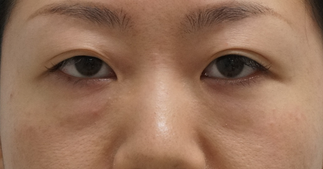 【術後2年9ヶ月】★60　28歳女性　老けて見えるクマを大幅改善　経結膜脱脂術+眼窩脂肪注入